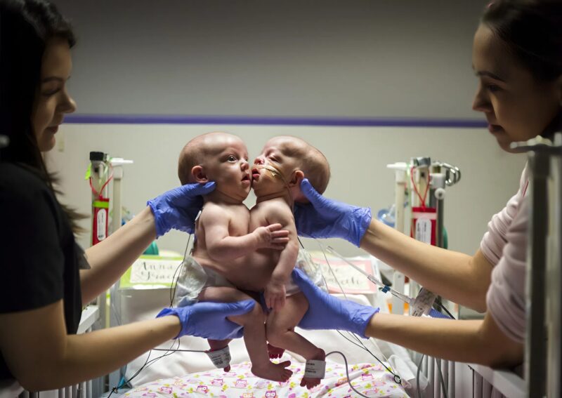 The twin sisters were born joined at the chest and abdomen: you will be shocked when you see them after the separation