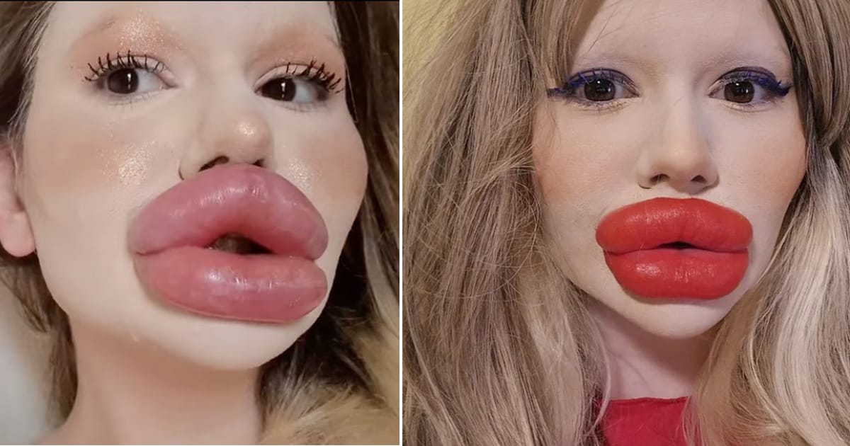 Woman obsessed with getting ”the biggest lips” in the world reveals how she looked before
