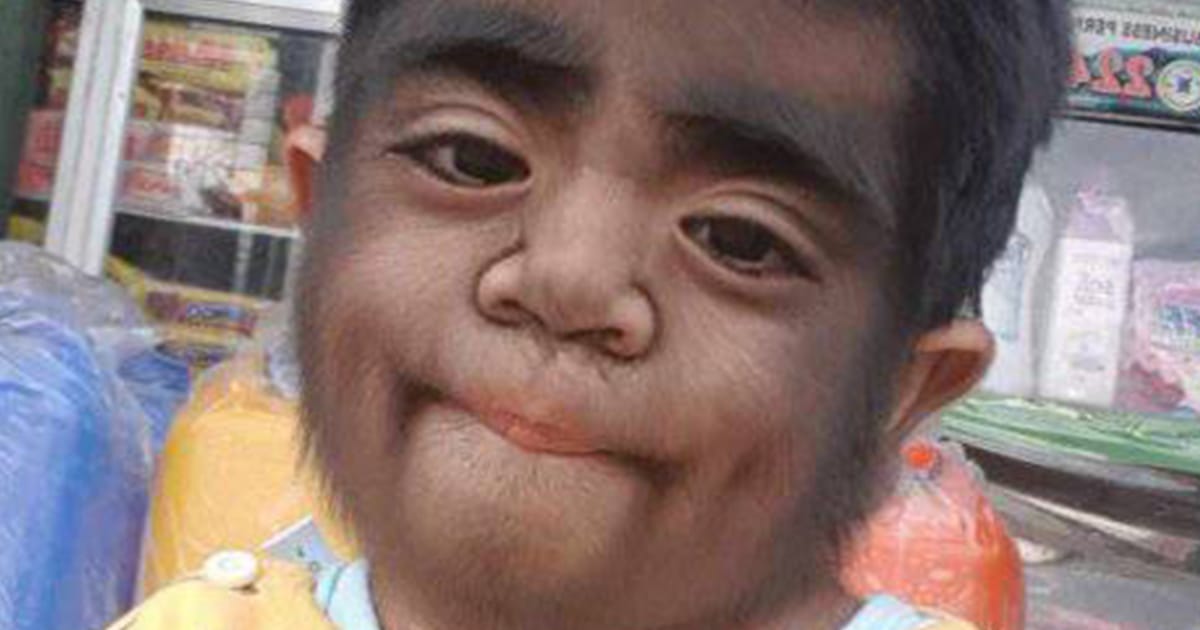 Mom fears her son’s ‘werewolf condition’ was caused by her act during pregnancy
