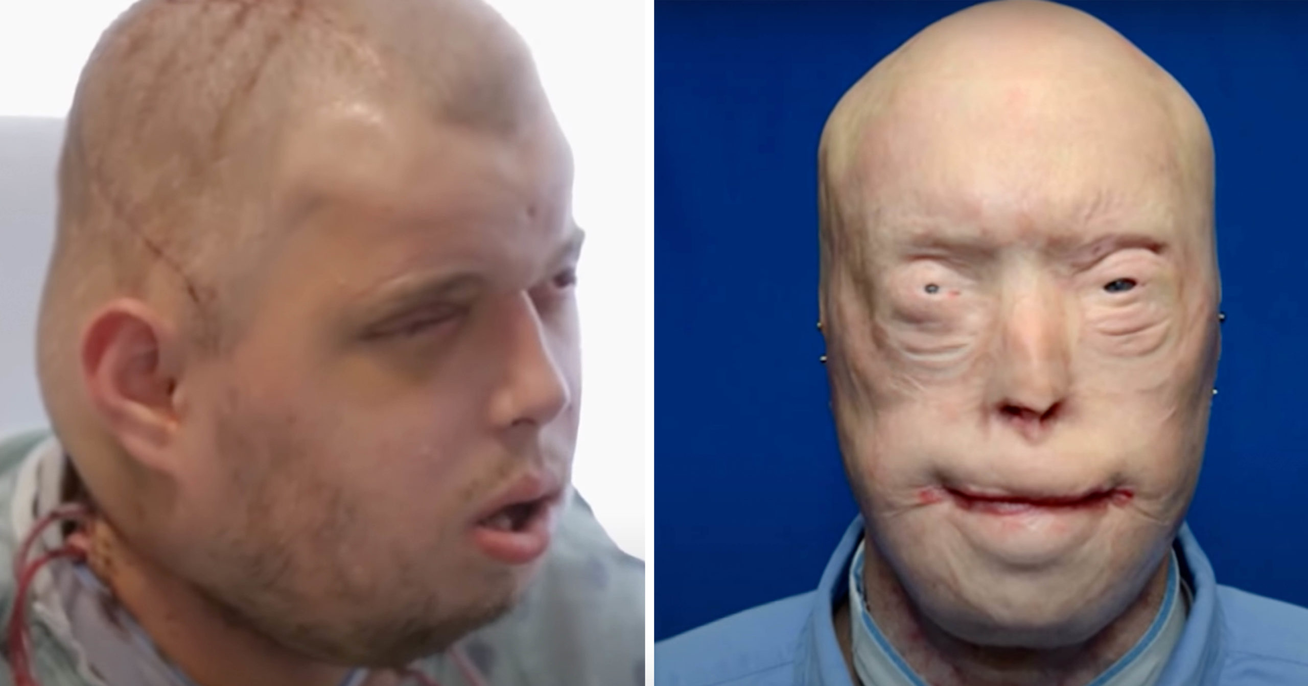 Brave firefighter has face transplant after suffering third-degree burns, & survives against all odds